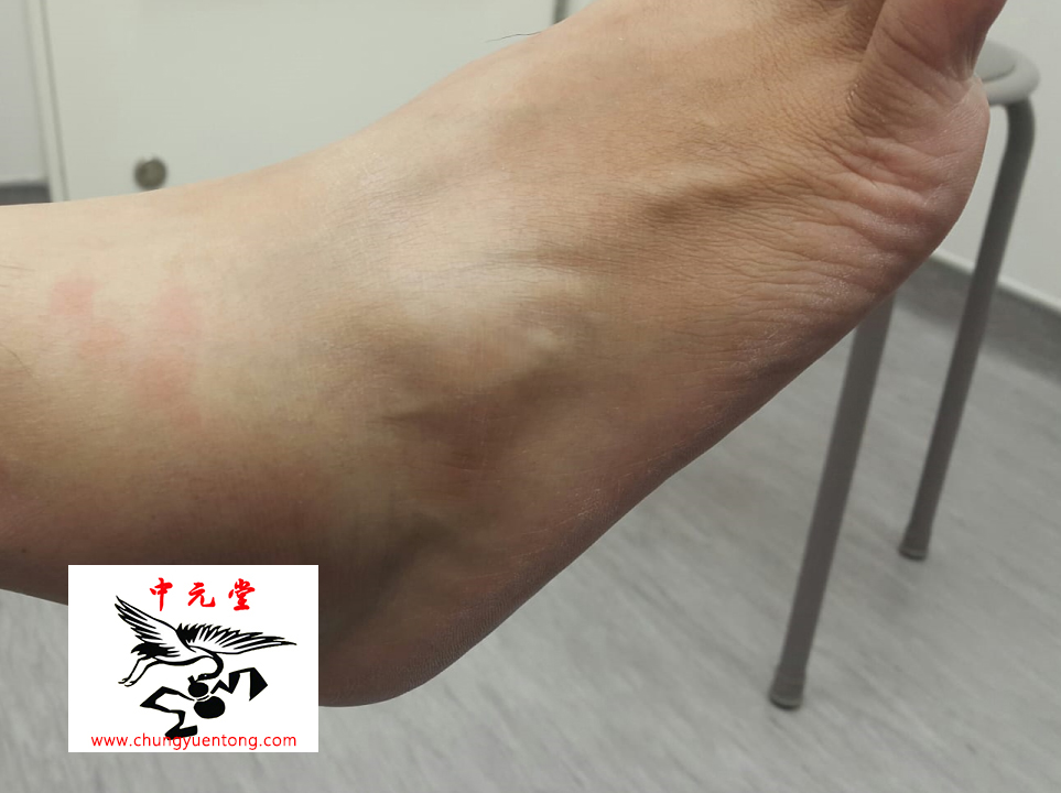 足踝關節扭挫傷，俗稱拗柴 1