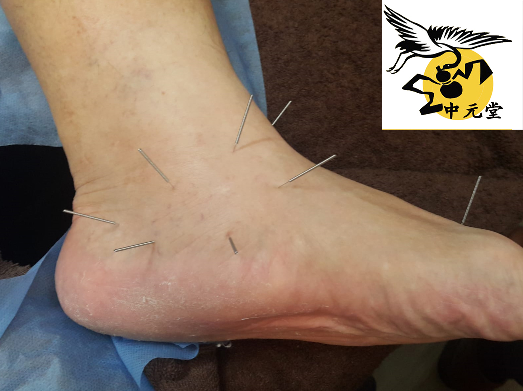 針灸如何治療生骨刺 1