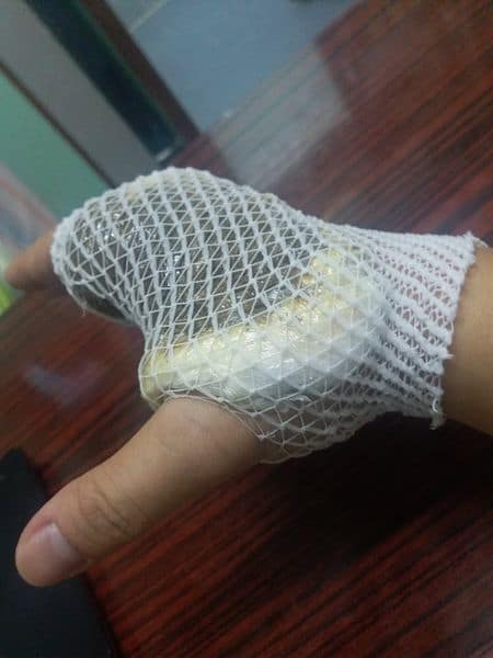 跌打正骨整脊復位針炙及拔罐