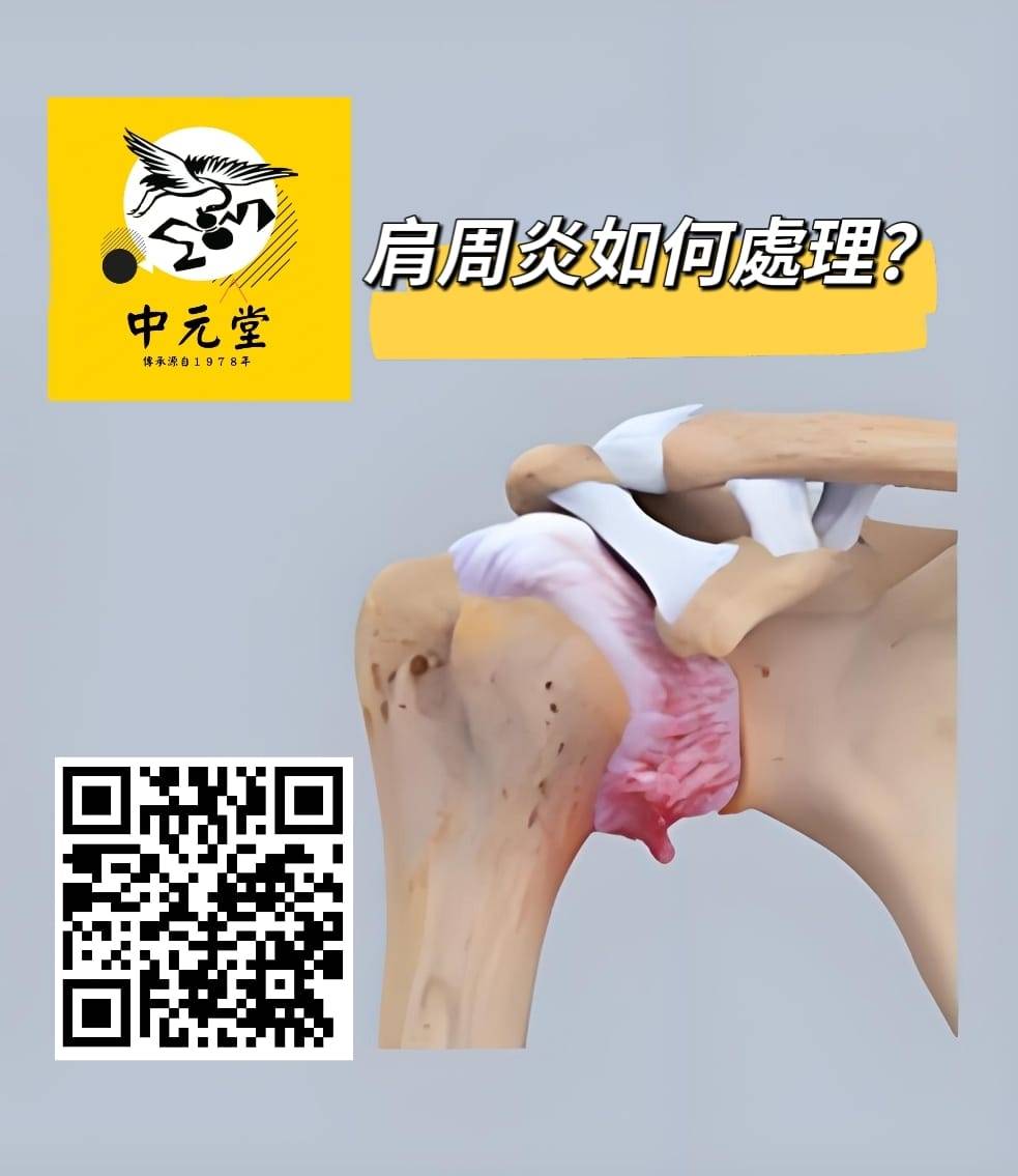 肩周炎如何處理？